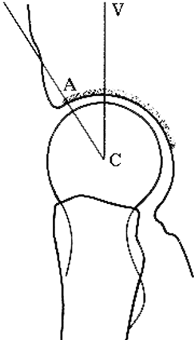 La coxarthrose