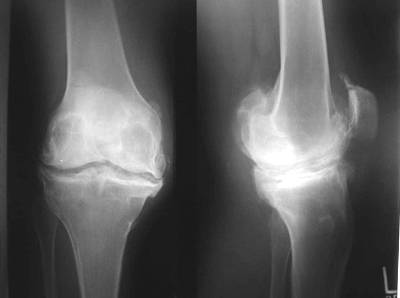 Définition, symptômes et diagnostic de l'arthrose du genou