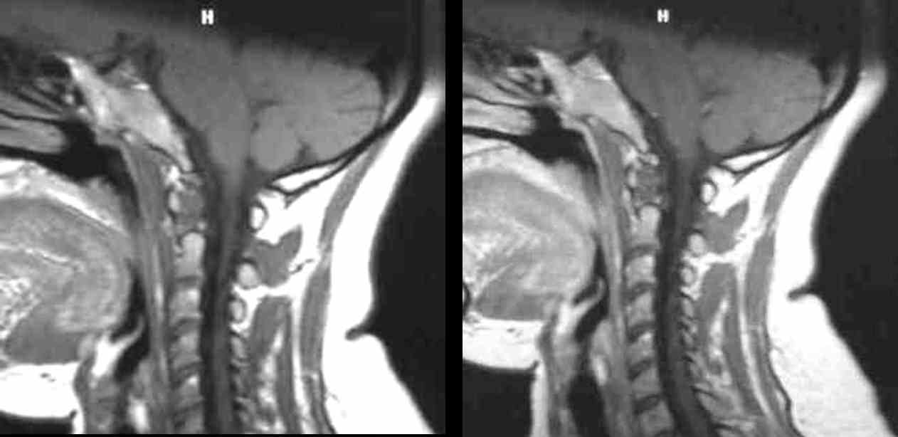 Imagerie du rachis cervical au cours de la polyarthrite rhumatoïde